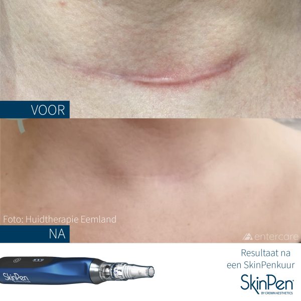SkinPen-voor-en-na-skinpenkuur-huidtherapie-eemland-litteken-hals-600x600.jpeg