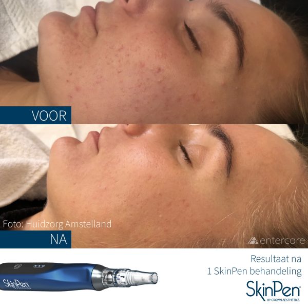 SkinPen-voor-en-na-1-behandeling-huidzorg-amstelland-600x600.jpeg